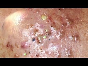 Satisfying and Relaxing with Squeezing Acne, Acne Severe, Hidden Acne, Acne Treatment #34