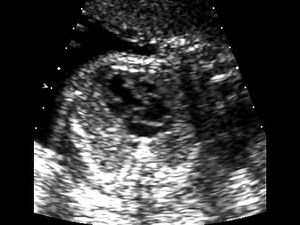 Hypoplastic Right Heart