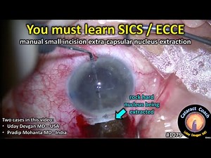CataractCoach 1079: learning SICS / ECCE manual cataract extraction