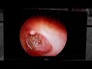 Maggots in ear