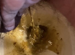 Liquid Diarrhea and Wiping