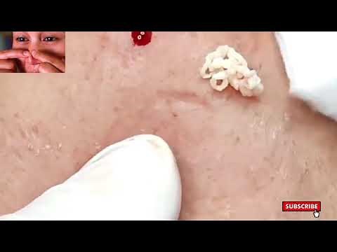 SO MUCH Deep Whitehead & Sebum Extractions! Macro View