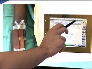 Ellipsys percutaneous AVF creation, Le Quotidien Du Medecin