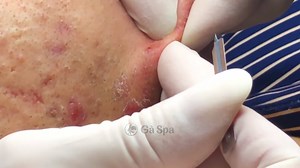 SIGNATURE SERVICE- Acnes Treatment (Ver.4) #Acnetreatment #Squeezeacne | Squeeze acne