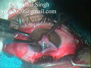 Conjunctival Graft Harvesting For Pterygium Excision With Autograft By Dr Sudhir Singh #32