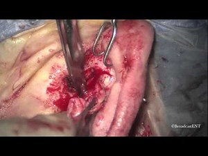 Canal Wall Down Mastoidectomy with Meatoplasty