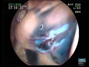 Enterobius vermicularis Infection