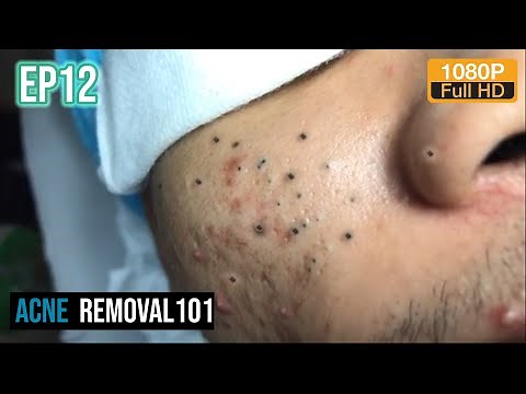 Cystic Acne Extraction 30mn , Blackheads Removal by ACNEREMOVAL101