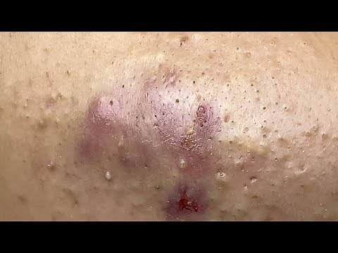 Inflammatory Acne P1 (Minh) | Mụn Viêm Tụ Máu P1 (MINH) - SacDepSpa#329