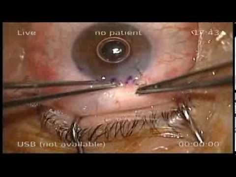 Cirugía de glaucoma con dispositivo Ex-Press y DINOP