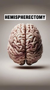 🧠 Hemispherectomy: Removing or disconnecting one hemisphere of the brain.…🎯 Purpose: Treat severe epilepsy, when seizures are localized to one hemisphere.…🚸 Common in Children: Often performed on kids, as their brains can adapt better.…📉 Reduces Seizures: Significantly lowers seizure frequency, improves quality of life.…🛠️ Types: There are different types, like functional, anatomical, or hemidecortication.…🤹‍♂️ Post-surgery: Rehabilitation needed for motor skills, speech, and cognitive fun