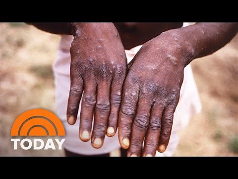 How To Identify A Monkeypox Rash: Symptoms To Look Out For