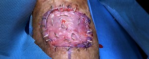 Squamous Cell Carcinoma Excision from Right Forearm with Split-Thickness Skin Graft from the Thigh | Journal of Medical Insight