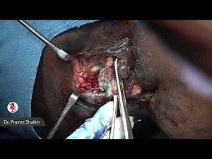 Fistulectomy Dr Pervez Shaikh [ ACRSICON 2025 ]