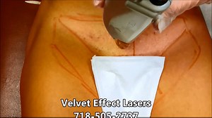 Professional Laser Hair Removal * Brazilian Bikini * Video #28 - Some of this video is in slow motion, then faster motion - Over 20,000 Brazilian bikinis done at this office * Since 2009 - Hair bumps and ingrown hairs WILL be reduced - At the highest rate science can provide - That's because we are using the Alexandrite Laser (755NM) by Candela - The Top choice of professionals in the industry * NON IPL - Our technicians can explain how and why this is better! If your's can not, you might want t