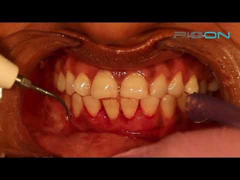 Laser curettage/debridement using S1 dental laser- 980nm wavelength