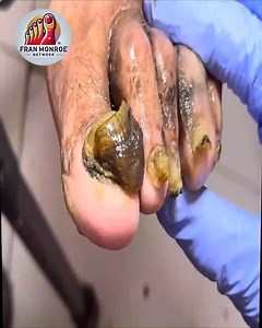 20K views · 208 reactions | Smart Health Tips for Senior Nail Care As Part of Holistic Wellness #EverydayCare #DiabeticFootCare #SafeSteps #FootSupport | Fran Monroe | Facebook