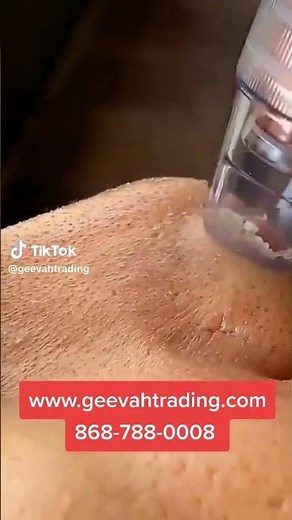 Easy-to-Use Electric Pore Extractor - Gentle & Effective Blackhead Removal