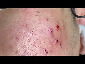 Acne Treatment Huong beauty | 1600