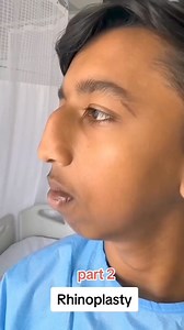 Rhinoplasty, also known as a nose job or nasal surgery, is a plastic surgery procedure that involves reshaping and reconstructing the nose through surgical manipulation of the bone and cartilage. The goal of rhinoplasty can be cosmetic (just for looks) or functional (helps with better breathing) #kbkfoundation | Kbkonline