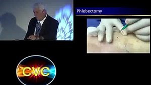 Step-by Step: How I Perform Phlebectomy