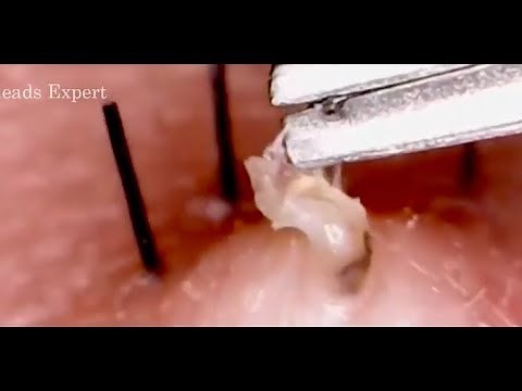 BLACKHEADS X100 MAGNIFIED EXTRACTED SLIMY AND GROSS! LOOKS LIKE MAGGOTS!