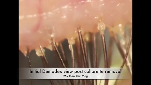 5 Best Natural Demodex Remedies to Get Rid of Eyelash Mites & Bugs