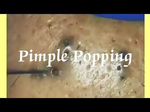 Pimple & Blackheads Popping - 46