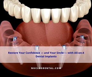 🦷 All-on-4: A New Smile at Any Age Missing teeth? Tired of loose dentures? The All-on-4 technique offers a fixed, natural-looking solution — ideal for seniors. ✔️ Full-arch restoration ✔️ Minimally invasive ✔️ Immediate results Regain comfort, function & confidence — book your consultation today. 📲 #AllOn4 #DentalImplants #SeniorSmiles . 📱🦷 915 308 0101 nucleodental.com | Nucleo Dental