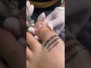 Surgical Guide to Ingrown Toenail Removal in Ca Mau Province P02