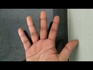 Claw Hand | complete claw hand | Partial claw hand| Ulnar nerve injury | Paralysis of lumbricals