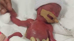 ‘Little fighter’: World’s smallest known baby discharged from hospital