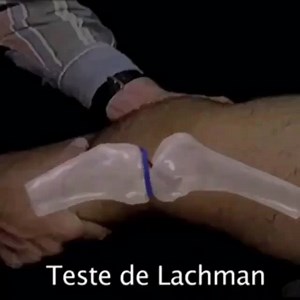 Teste de Lachman: 🔥Descrição🔥 O teste de Lachman é um teste de movimento passivo acessório do joelho, que é executado para identificar a integridade do ligamento cruzado anterior, ou LCA. O teste foi desenvolvido para avaliar a instabilidade do joelho no plano sagital. 🔥Técnica🔥 Com o paciente deitado de barriga para cima, coloque o joelho do paciente a cerca de 20-30º de flexão e a perna deve ser rodada externamente. O examinador deve colocar uma mão atrás da tíbia e outra na coxa do pacien