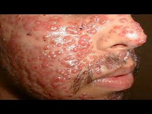 Amazing Large Blackheads Extraction BIG Cystic Acne Blackheads&Whiteheads Removal Pimple Popping #8