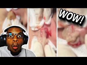 MASSIVE EAR CYST POPS YOU WILL NOT BELIEVE!