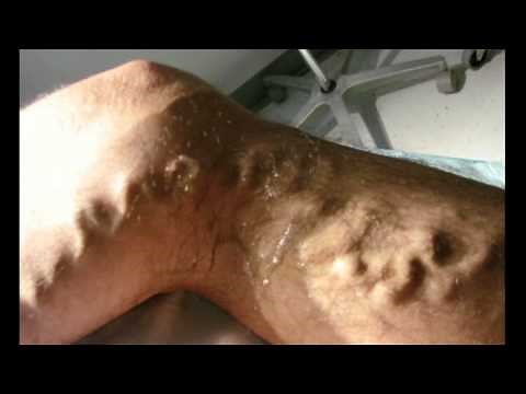 Veins Without Surgery