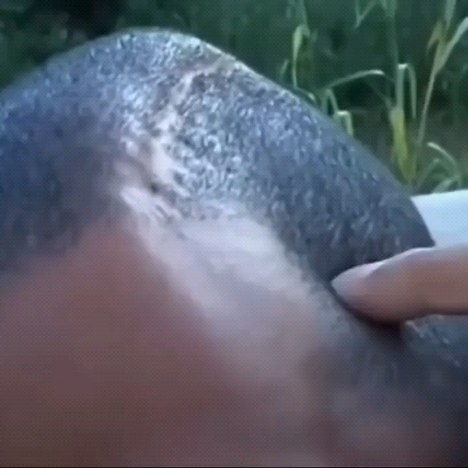 MedWorld- Medical & Health | Today we would like to show you a neurosurgical case of hemicraniectomy. Decompressive craniectomy is a neurosurgical procedure in which... | Instagram