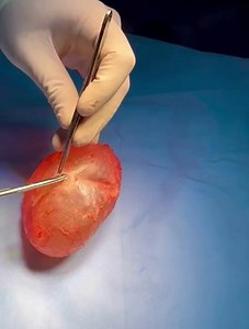 Severe Capsular contracture