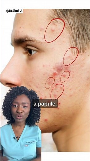 Red Spots on Your Face | Acne Papules + Products #acne