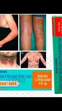 Sonaderm NM Cream||Clobetasol Propionate, Neomycin Sulphate & Miconazole Nitrate Cream||Skin Cream
