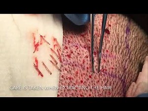 Follicular Unit Extraction (FUE) Hair Transplant by Dr. Thomas Nakatsui