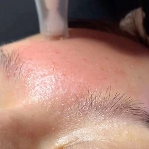 SkinPen Microneedling with PRP. SkinPen works on all skin types and is great for acne scars, wrinkles, uneven skin tone, & large pore size! . . #skinpen #skinpenmicroneedling #microneedling #microneedlingtherapy #microneedlingprp #PRP #acnescars #acnetips #antiaging #medicalspa #wherehealthandbeautymeet #skinexperts | Vitality Anti Aging Center