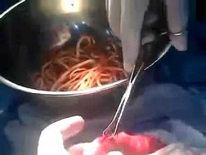 Removing Intestinal Worms and Parasites from a 3 Year Old