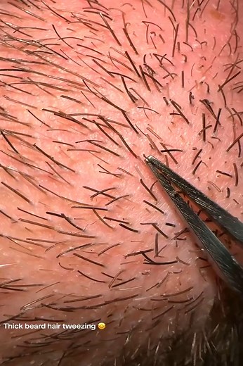 My Multigemini hair tweezing🚀✨ #BeardPlucking #Multigemini #TweezerLove #WifeGrooming #HusbandCare #BeardCare #PluckingSatisfaction #ASMRBeauty2 | Eithan Dickerson