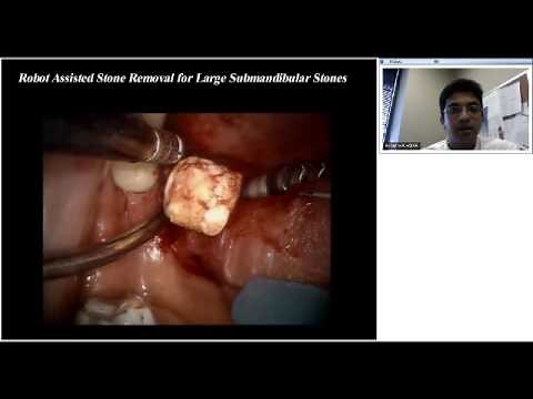 Global Grand Rounds: Sialendoscopy presented by Rohan R. Walvekar, MD