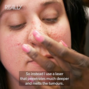 Lauren's having laser treatment for face lesions but will she be happy with the results? 🩺 #DrMercy | Love Medical