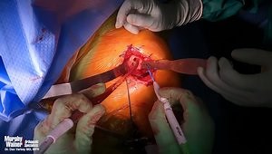 Stemless Anatomic Total Shoulder Arthroplasty With Double Row Suture Based Subscapularis Repair