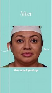 Otoplasty Reveal - Patient Reacts!