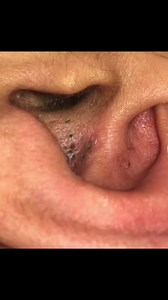 #satisfyingvideos #extraction #pimplepopper #blackhead #fyp
