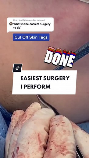 How to Safely Remove Skin Tags | Step-by-Step Guide